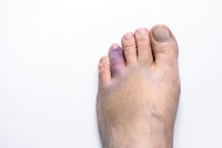 Causes and Care for a Broken Toe