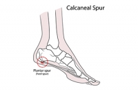 Symptoms and Risk Factors of Heel Spurs