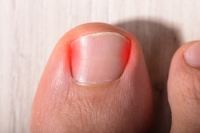 Post-surgical Care For Ingrown Toenails