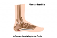 Heel Pain and Plantar Fasciitis