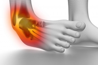 Managing Various Grades of Ankle Sprains