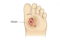 What Are Diabetic Foot Ulcers?