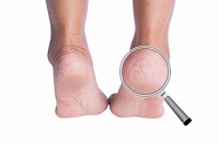 Understanding the Risk Factors for Cracked Heels
