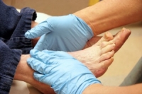 Checking for Scrapes, Cuts, or Bruises on Diabetic Feet