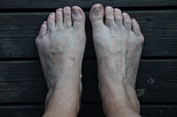 Bunions on the Outside of the Foot