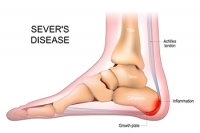 Understanding Sever's Disease