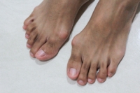 Symptoms and Risk Factors of Bunions