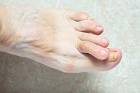 Definition and Root Causes of Hammertoe