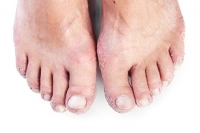 Relief for Psoriatic Foot Arthritis