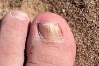 Addressing Toenail Fungus